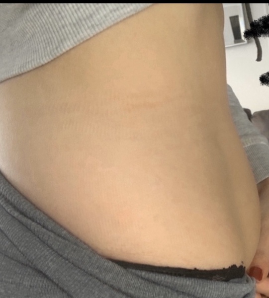 I’ve had fat reducing injections