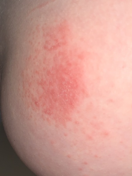 Can anyone help identify this rash?