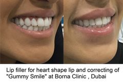 Botox for gummy smile
