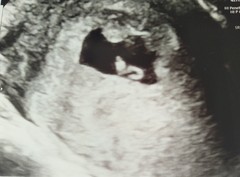 Square shaped gestational sac :-(