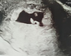 Very irregular shaped gestational sac :-(