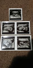 Hi I'm expecting twins. Could someone pls help me with nub theory x