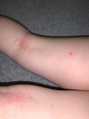 Can anyone help identify this rash?