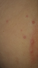 To think this is chicken pox again?