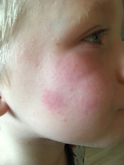 What is this rash (pretty sure it isn’t slap cheek)