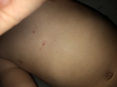 To think this is chicken pox again?