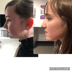 Twin Block Braces - Any Advice?