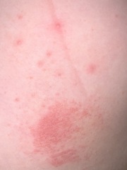 Can anyone help identify this rash?