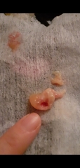 Very gross picture I just coughed this up any Docters and ENT specialists about?