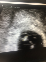 Low heart beat and big yolk sac, please help!