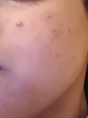 Please help me to sort my skin out. Pics attached