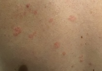 Shingles