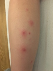 Bedbugs