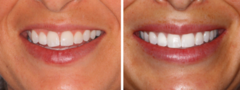 Botox for gummy smile