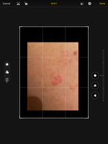 Shingles
