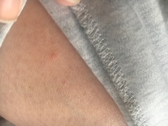 What are these itchy spots all over my body (photo)?
