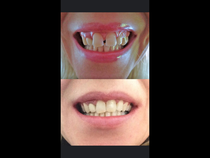 Have you had your teeth fixed? Experiences etc...