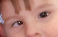 Anyone had a squint in both eyes?