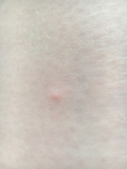 What are these itchy spots all over my body (photo)?