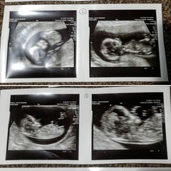 Hi I'm expecting twins. Could someone pls help me with nub theory x