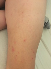 Bedbugs