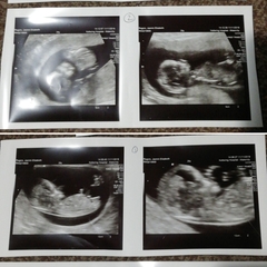 Hi I'm expecting twins. Could someone pls help me with nub theory x
