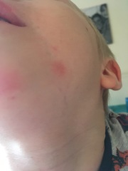 What is this rash (pretty sure it isn’t slap cheek)