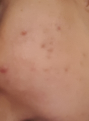 Please help me to sort my skin out. Pics attached