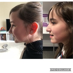 Twin Block Braces - Any Advice?