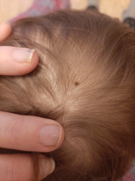 Mark on skin growing