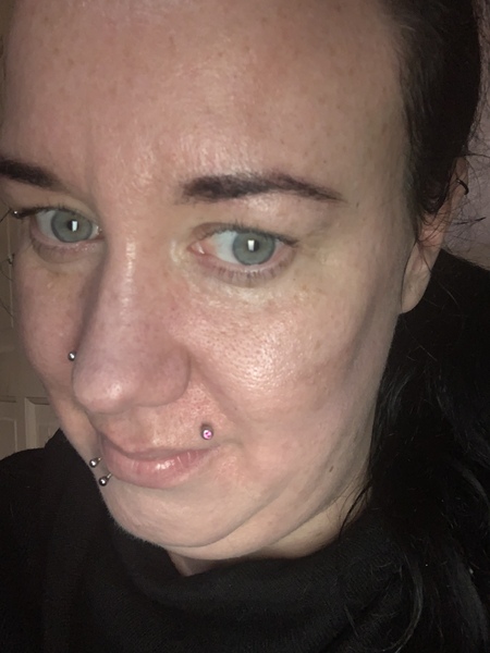 To Botox or not to Botox