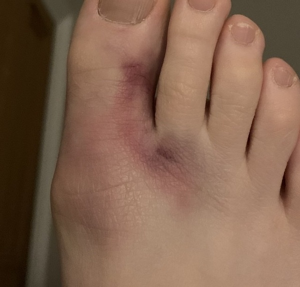 Doctor with suspected broken big toe?