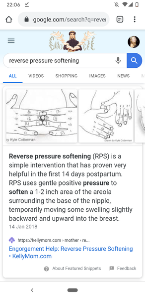 Engorgement