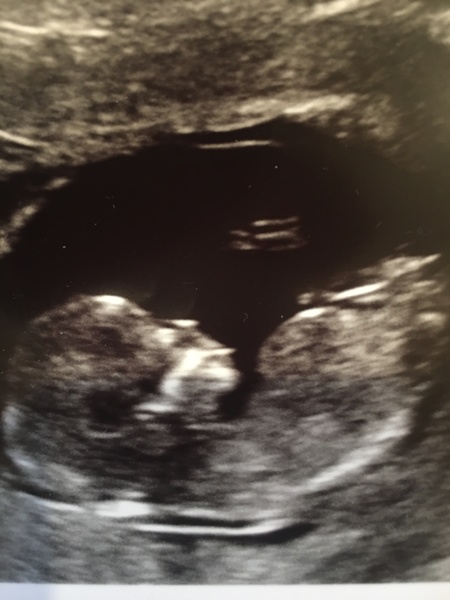 Twin pregnancy but only one heartbeat