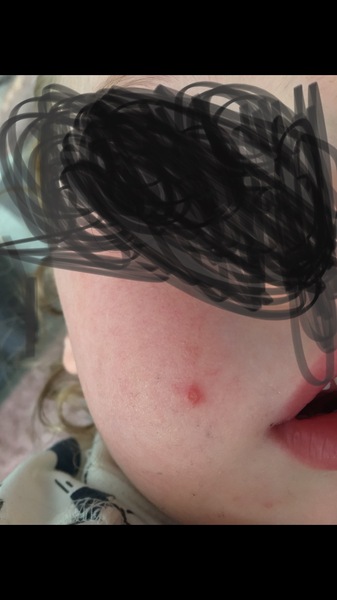 AIBU to not know if this is chickenpox or not?