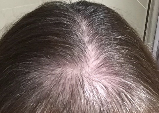 Regaine/Minoxidil users support thread