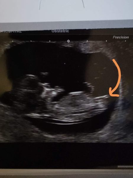 Is this the nub?