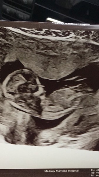 GIRL OR BOY 13 weeks