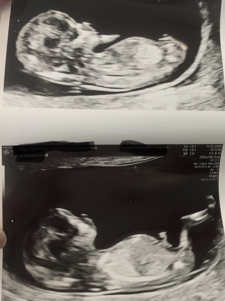 Just had a 12 week scan. Nub/skull theory guesses please? :)