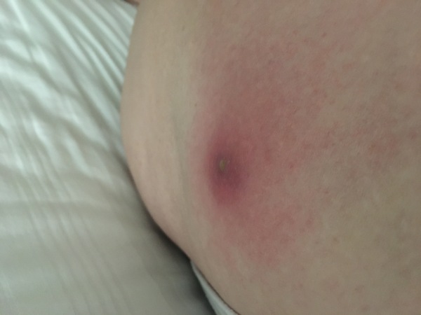 Skin infection