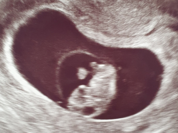 8 week scan