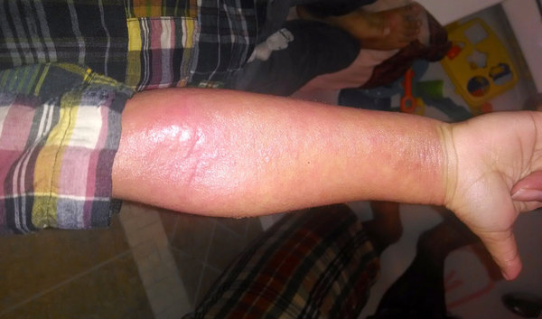 Eczema - any advice?