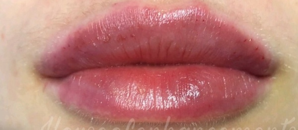 Lip Fillers