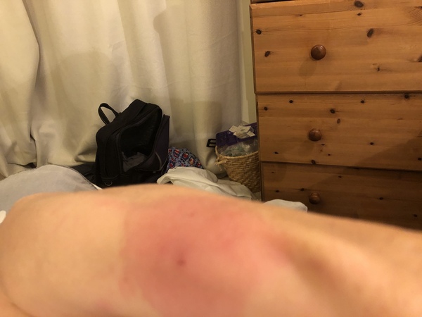 Cat bite infected?