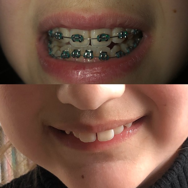 Twin Block Braces - Any Advice?