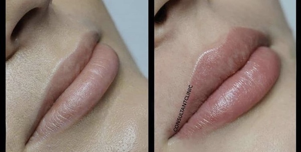 Lip Fillers