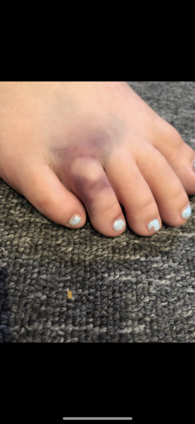 Doctor with suspected broken big toe?