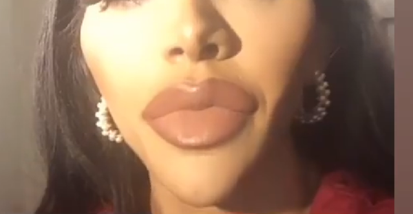 Lip filler, how much? Pic included