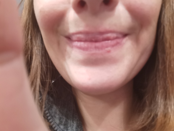 Lips scarred by coldsores