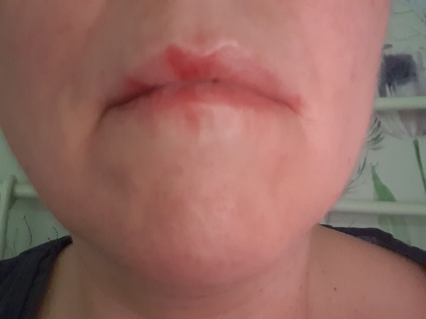 Manky lips...bluergh (pic inc)
